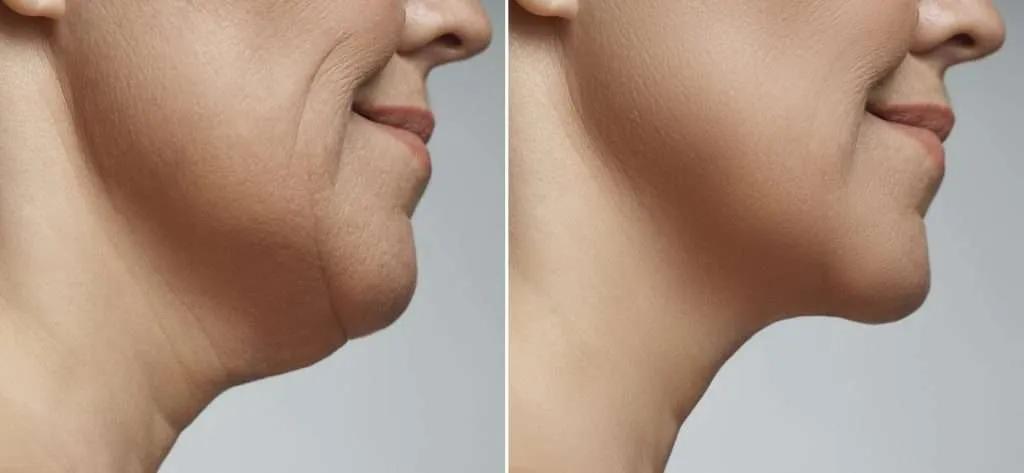 The-Best-Jawline-Sculpting-Treatments--1024x473.jpg